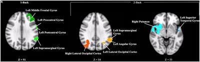 Reduced brain activity during a working memory task in middle-aged apolipoprotein E ε4 carriers with overweight/obesity